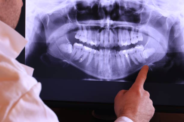 Best Emergency Wisdom Teeth Removal in Shenandoah, TX